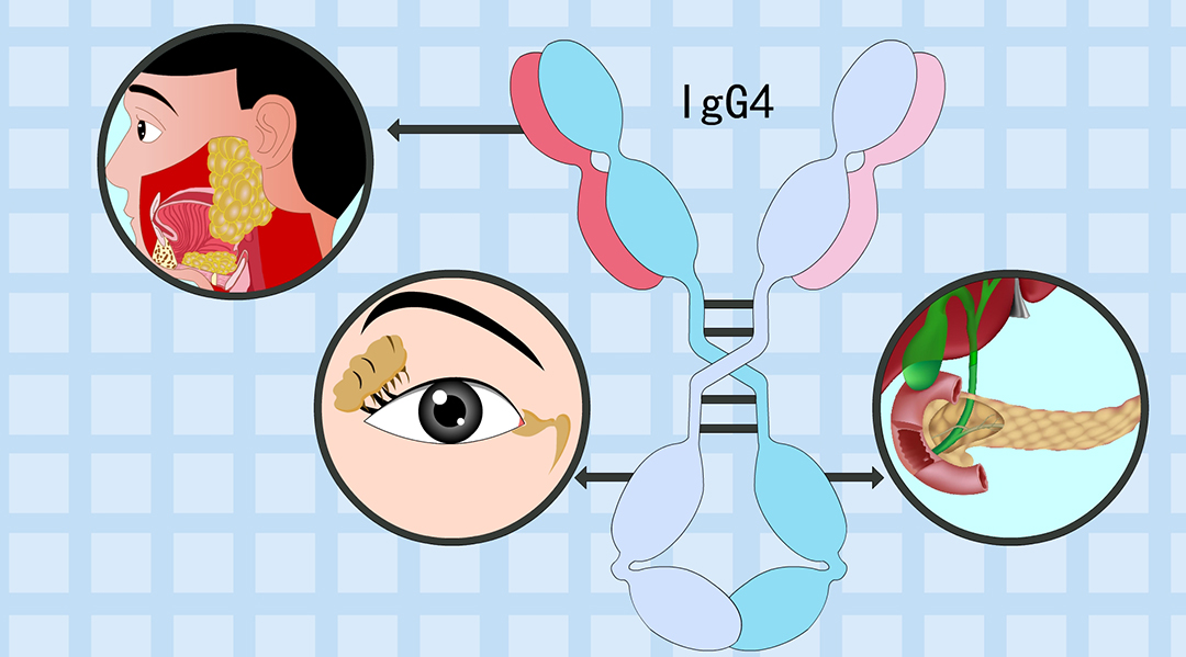 一文帶你了解IgG4這個(gè)指標(biāo)